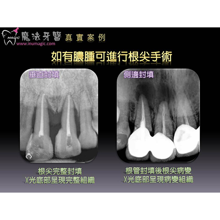 根尖手术 - Dental Endodontic-7 根尖手术 - Dental Endodontic-7