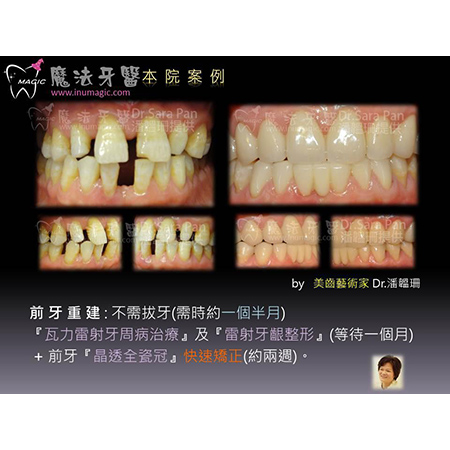 美白贴片 - Dental Esthetics-6 美白贴片 - Dental Esthetics-6