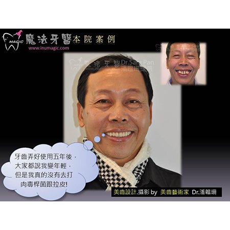 牙周病治疗方式 - Periodontal Disease Treatment-3 牙周病治疗方式 - Periodontal Disease Treatment-3