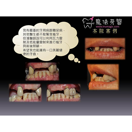 牙周病症状 - Periodontal Disease Treatment-4 牙周病症状 - Periodontal Disease Treatment-4