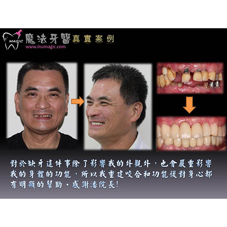缺牙 - Dental Implants-20 缺牙 - Dental Implants-20