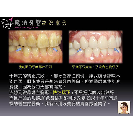 美白牙齿贴片 - Dental Esthetics-12 美白牙齿贴片 - Dental Esthetics-12