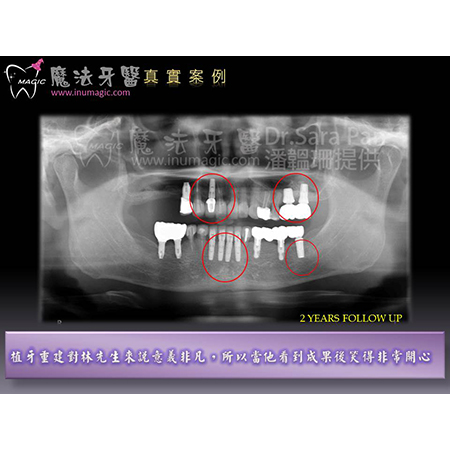 台北植牙 - Dental Implants-3 台北植牙 - Dental Implants-3