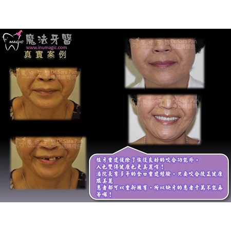 植牙补骨 - Dental Implants-6 植牙补骨 - Dental Implants-6