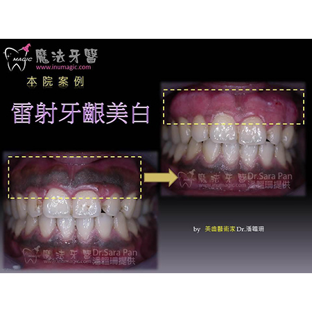 牙龈变白 - Dental Esthetics-3 牙龈变白 - Dental Esthetics-3