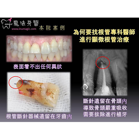显微根管治疗 - Dental Endodontic-4 显微根管治疗 - Dental Endodontic-4