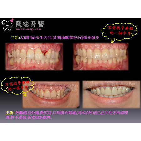牙龈发炎 - Periodontal Disease Treatment-2 牙龈发炎 - Periodontal Disease Treatment-2