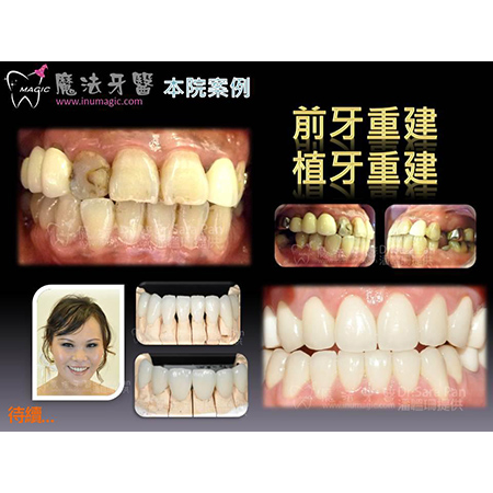 美白牙齿 - Dental Esthetics-11 美白牙齿 - Dental Esthetics-11