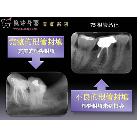 根管钙化 - Dental Endodontic-1 根管钙化 - Dental Endodontic-1