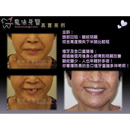 台北市植牙 - Dental Implants-5 台北市植牙 - Dental Implants-5