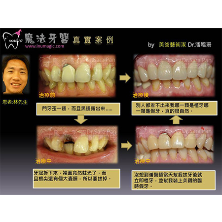 门牙植牙 - Dental Implants-12 门牙植牙 - Dental Implants-12