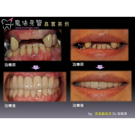 牙齿缺牙 - Dental Implants-21 牙齿缺牙 - Dental Implants-21