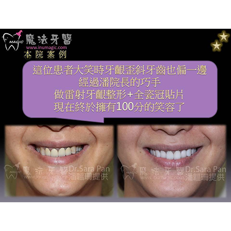 贴片 - Dental Esthetics-15 贴片 - Dental Esthetics-15