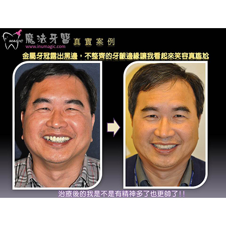 牙周病激光疗法 - Dental Laser-4 牙周病激光疗法 - Dental Laser-4