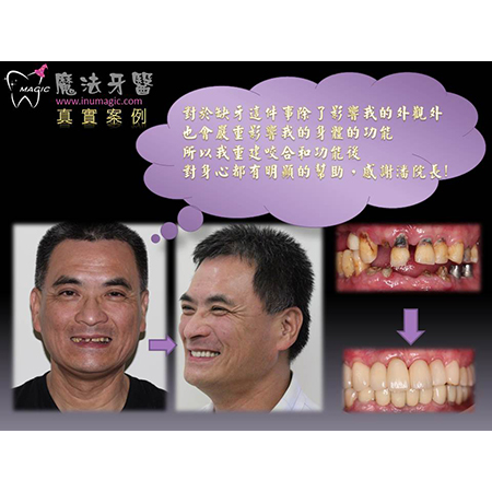 全口重建费用 - Full Mouth Reconstruction-1 全口重建费用 - Full Mouth Reconstruction-1