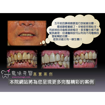 植牙过程 - Dental Implants-1 植牙过程 - Dental Implants-1