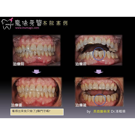 牙齿拥挤 - Dental Esthetics-5 牙齿拥挤 - Dental Esthetics-5