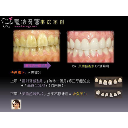 3D齿雕 - Dental Esthetics-8 3D齿雕 - Dental Esthetics-8