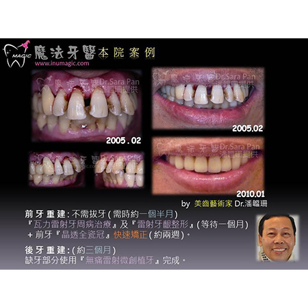 牙周病治疗方法 - Periodontal Disease Treatment-1 牙周病治疗方法 - Periodontal Disease Treatment-1