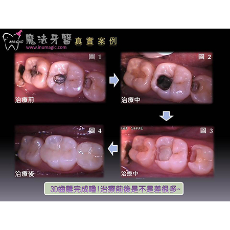 假牙补助 - Dental Prosthodontics-4 假牙补助 - Dental Prosthodontics-4