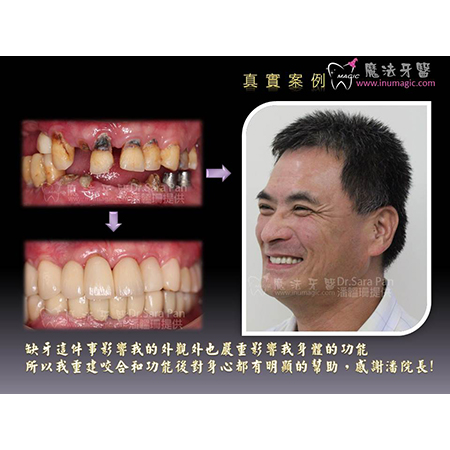 植牙诊所 - Dental Implants-4 植牙诊所 - Dental Implants-4