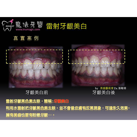 牙龈美白 - Dental Esthetics-2 牙龈美白 - Dental Esthetics-2
