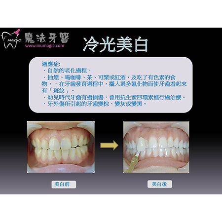 冷光美白 - Dental Esthetics-10 冷光美白 - Dental Esthetics-10