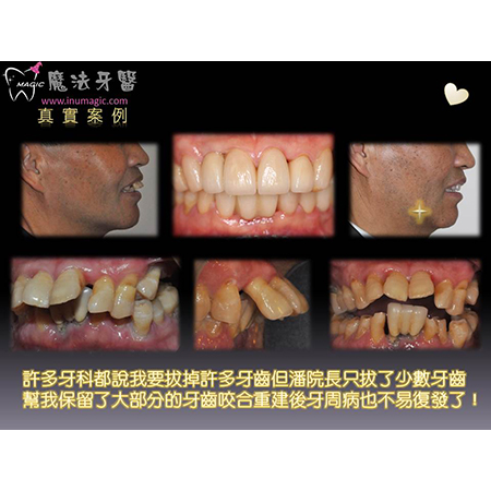 植牙医生 - Dental Implants-10 植牙医生 - Dental Implants-10