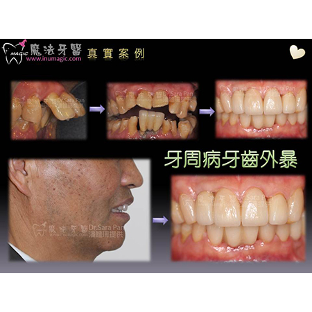 种牙 - Dental Implants-9 种牙 - Dental Implants-9