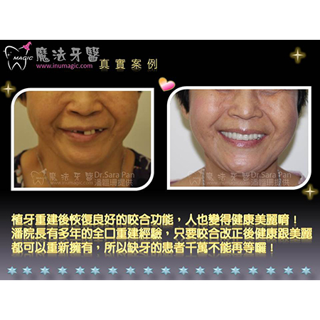 牙医植牙 - Dental Implants-7 牙医植牙 - Dental Implants-7