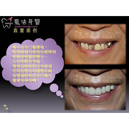 植牙费用 - Dental Implants-11 植牙费用 - Dental Implants-11