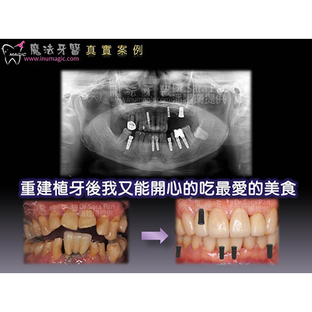 人工植牙过程 - Dental Implants-8 人工植牙过程 - Dental Implants-8