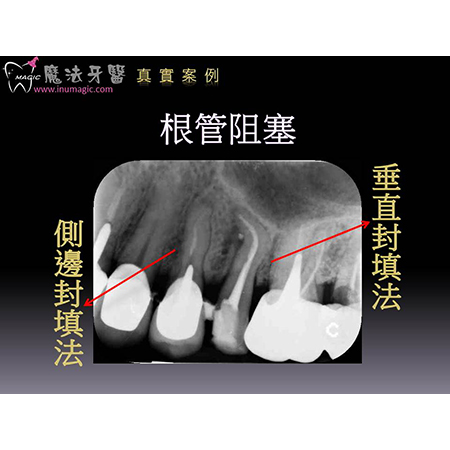 牙医根管治疗 - Dental Endodontic-2 牙医根管治疗 - Dental Endodontic-2