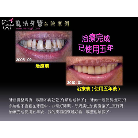 牙周病疗程 - Dental Laser-3 牙周病疗程 - Dental Laser-3