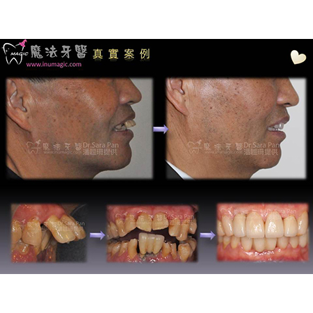 无痛植牙 - Dental Implants-13 无痛植牙 - Dental Implants-13