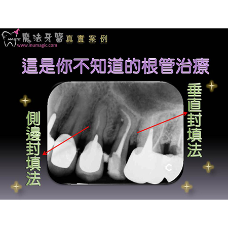 抽神经 - Dental Endodontic-5 抽神经 - Dental Endodontic-5