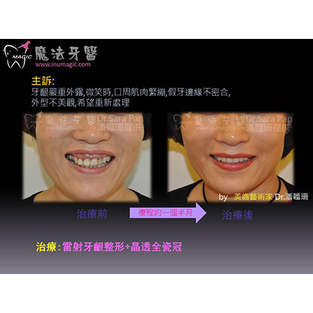 牙齿重建 - Full Mouth Reconstruction-6 牙齿重建 - Full Mouth Reconstruction-6