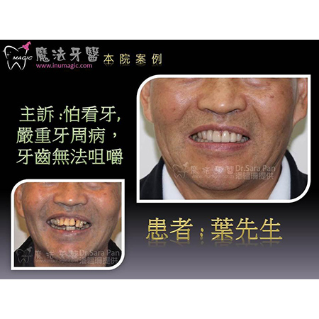 牙龈整形 - Full Mouth Reconstruction-2 牙龈整形 - Full Mouth Reconstruction-2