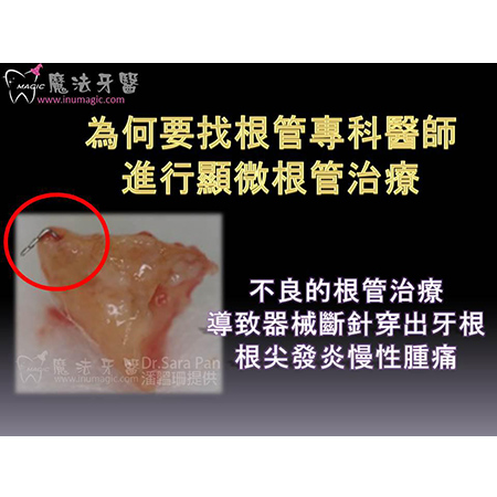 显微镜根管治疗 - Dental Endodontic-6 显微镜根管治疗 - Dental Endodontic-6