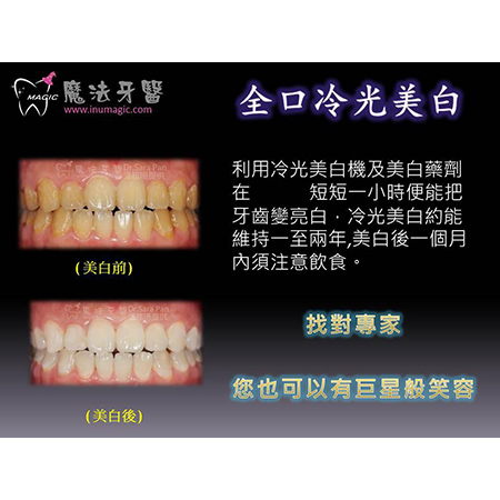 居家美白 - Dental Esthetics-14 居家美白 - Dental Esthetics-14