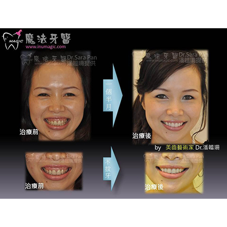 笑露牙龈 - Full Mouth Reconstruction-7 笑露牙龈 - Full Mouth Reconstruction-7