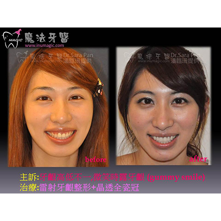 牙龈外露整形 - Full Mouth Reconstruction-3 牙龈外露整形 - Full Mouth Reconstruction-3