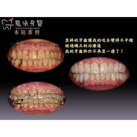 透明矫正器 - Dental Orthodontic-10 透明矫正器 - Dental Orthodontic-10