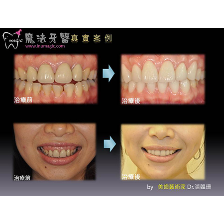 正颚手术 - Dental Orthodontic-8 正颚手术 - Dental Orthodontic-8