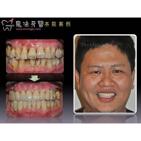 治牙周病 - Periodontal Disease Treatment-6 治牙周病 - Periodontal Disease Treatment-6