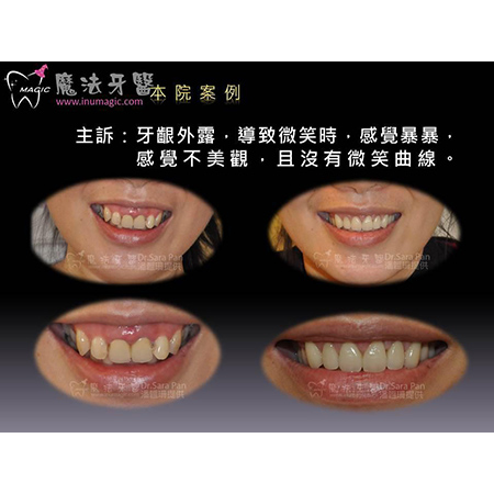 牙龈外露 - Full Mouth Reconstruction-5 牙龈外露 - Full Mouth Reconstruction-5