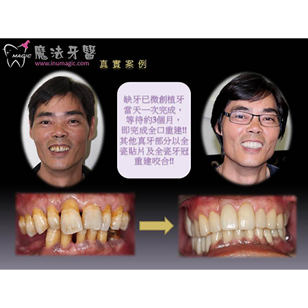 牙周治疗 - Dental Laser-2 牙周治疗 - Dental Laser-2