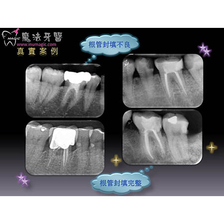 显微根管 - Dental Endodontic-3 显微根管 - Dental Endodontic-3