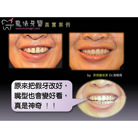 全口假牙 - Dental Prosthodontics-1 全口假牙 - Dental Prosthodontics-1