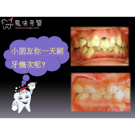 咬合不正 - Children Dental-2 咬合不正 - Children Dental-2